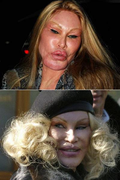 Самые известные жертвы пластической хирургии