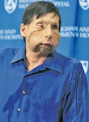 Американцы показали второго пациента с пересаженным лицом