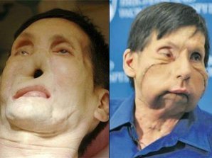 Американцы показали второго пациента с пересаженным лицом