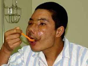 Американцы показали второго пациента с пересаженным лицом