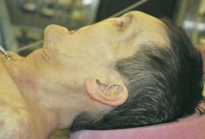 Американцы показали второго пациента с пересаженным лицом