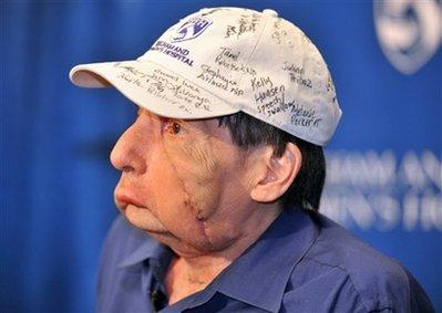 Американцы показали второго пациента с пересаженным лицом