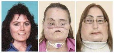 Американцы показали второго пациента с пересаженным лицом