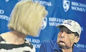 Американцы показали второго пациента с пересаженным лицом