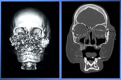 Американцы показали второго пациента с пересаженным лицом