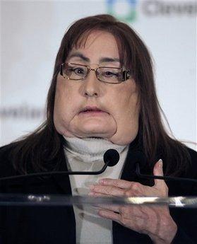 Американцы показали второго пациента с пересаженным лицом