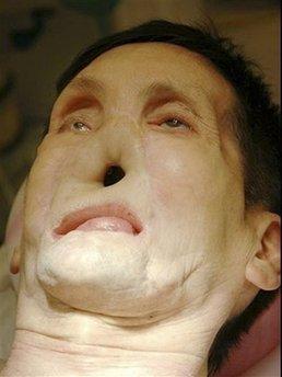 Американцы показали второго пациента с пересаженным лицом