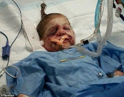 3-летнюю девочку, изуродованную питбулями, выгнали из закусочной из-за ее внешности