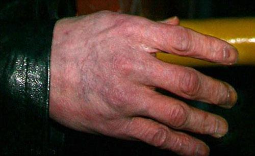 Носу Майкла Джексона пришёл конец?