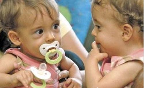 Самая удачная операция по разделению сиамских близнецов