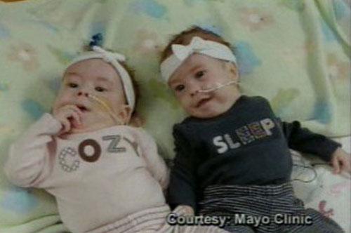 Самая удачная операция по разделению сиамских близнецов