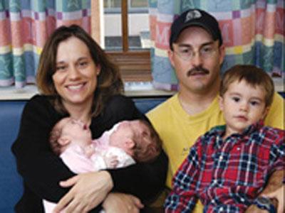 Самая удачная операция по разделению сиамских близнецов