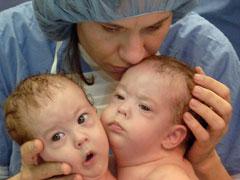 Самая удачная операция по разделению сиамских близнецов