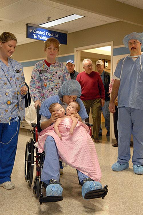 Самая удачная операция по разделению сиамских близнецов