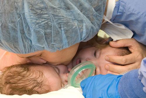 Самая удачная операция по разделению сиамских близнецов