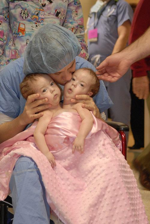 Самая удачная операция по разделению сиамских близнецов