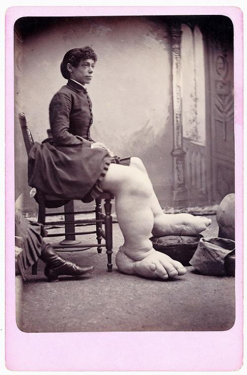 Фотографии людей из цирка уродов конца 19 века