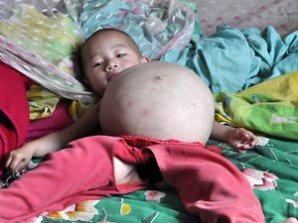 Маленькая  китаянка носит в животе неродившегося близнеца