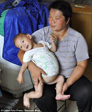 Маленькая  китаянка носит в животе неродившегося близнеца