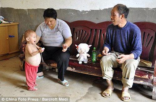 Маленькая  китаянка носит в животе неродившегося близнеца