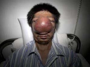 Врачи сделают операцию «человеку-носорогу»