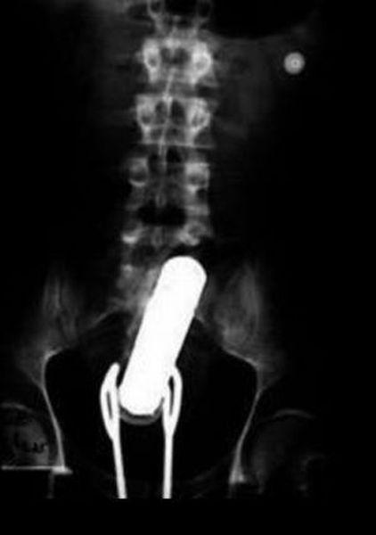 Предметы, которые можно обнаружить в человеке благодаря рентгену