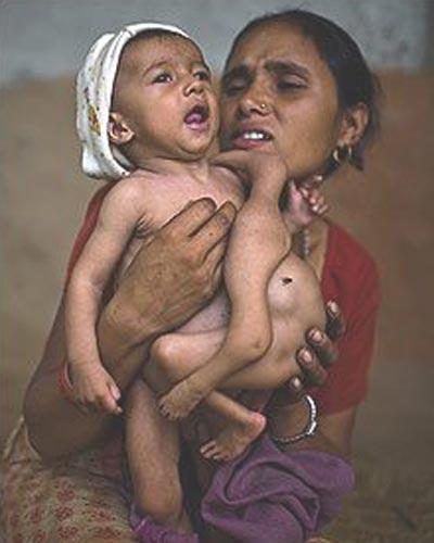 Четырёхрукому ребёнку из Непала поклоняются как богу