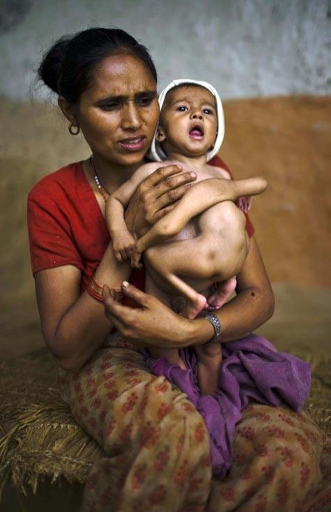 Четырёхрукому ребёнку из Непала поклоняются как богу