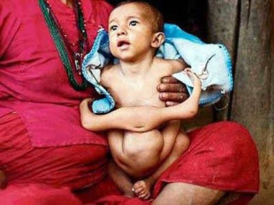 Четырёхрукому ребёнку из Непала поклоняются как богу