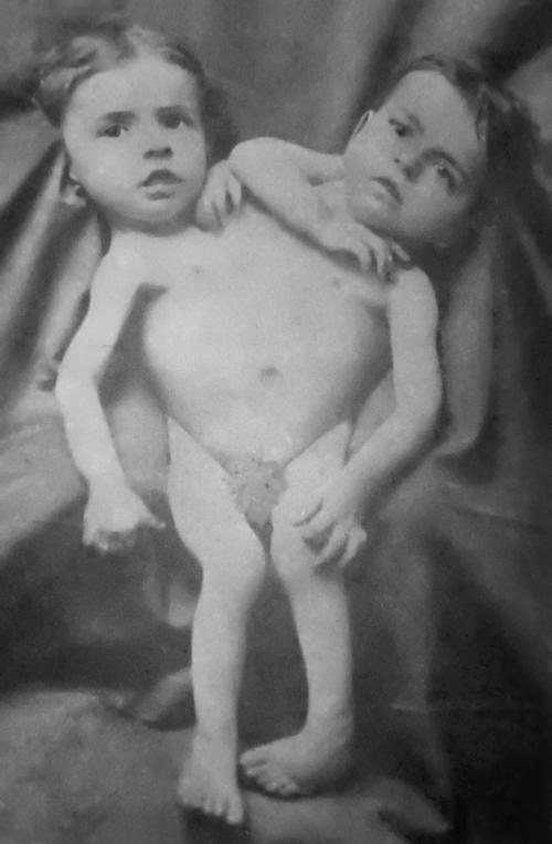 Подлинные истории самых известных сиамских близнецов