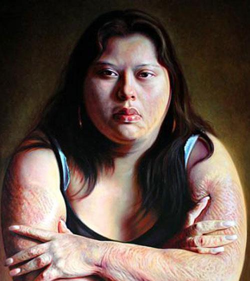 Портреты обожженных людей