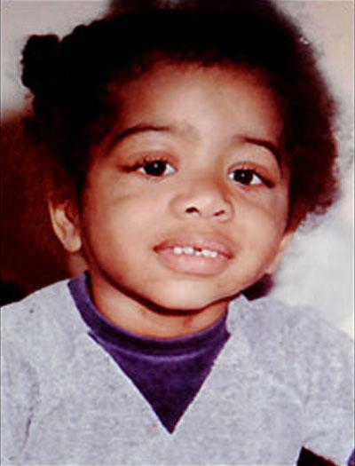 Современному человеку-слону пересадили новое лицо