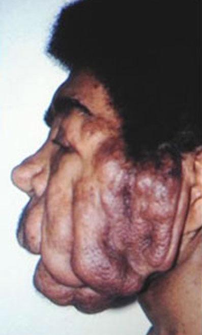 Современному человеку-слону пересадили новое лицо