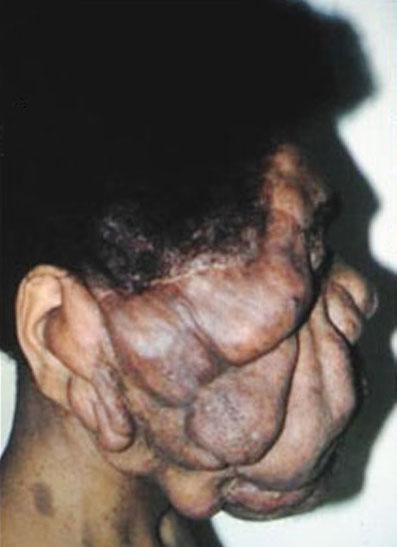 Современному человеку-слону пересадили новое лицо