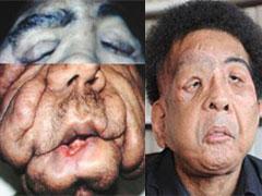 Современному человеку-слону пересадили новое лицо