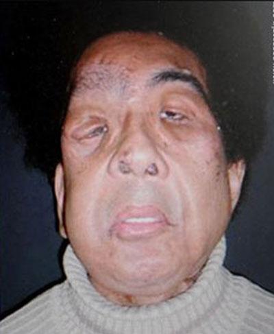 Современному человеку-слону пересадили новое лицо