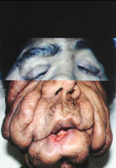 Современному человеку-слону пересадили новое лицо