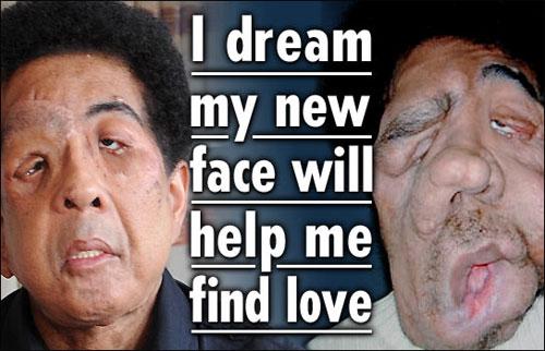 Современному человеку-слону пересадили новое лицо