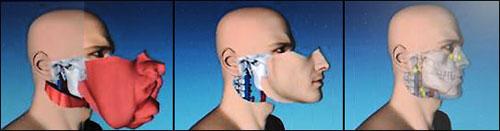 Современному человеку-слону пересадили новое лицо