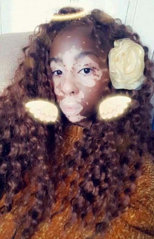 6 лет девушка прятала лицо за косметикой, потому что ее обзывали "зеброй"