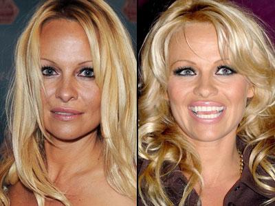 Губы: искусственные прелести знаменитостей