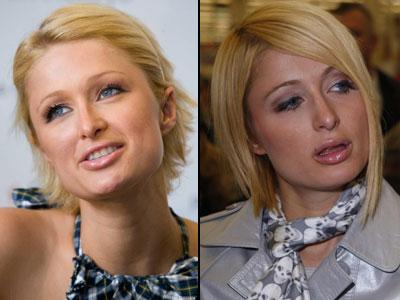 Губы: искусственные прелести знаменитостей