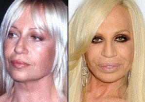 Губы: искусственные прелести знаменитостей