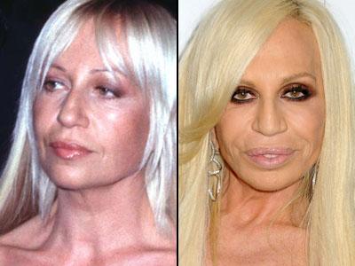 Губы: искусственные прелести знаменитостей