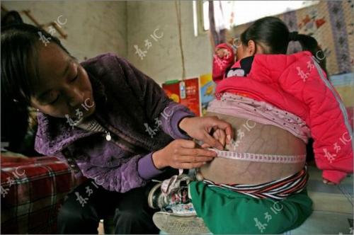 В Китае найдена 4-летняя "беременная" девочка