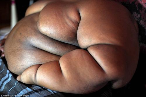 Самый толстый мальчик в мире похудел на 80 килограммов