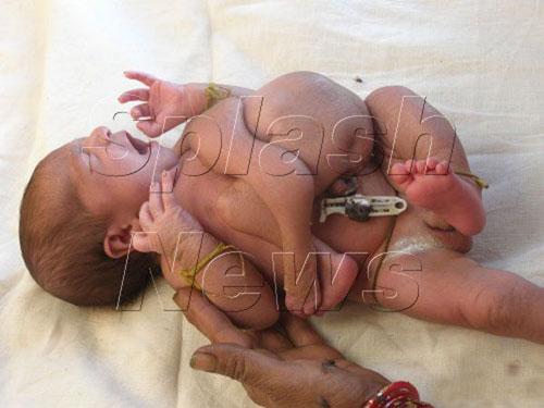 Аномальные дети чаще всего рождаются в Азии