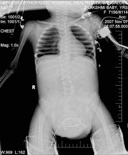 Аномальные дети чаще всего рождаются в Азии