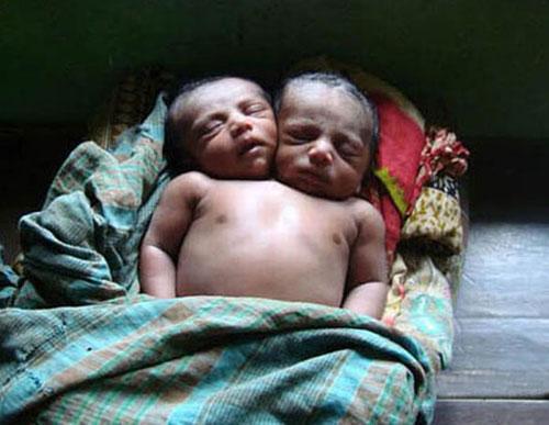 Аномальные дети чаще всего рождаются в Азии