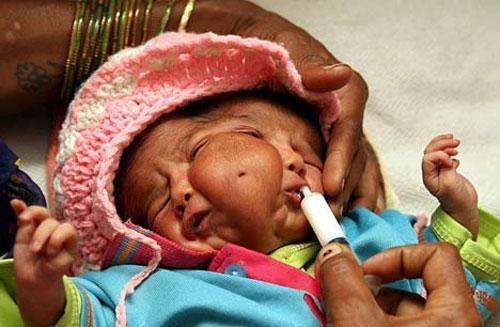 Аномальные дети чаще всего рождаются в Азии
